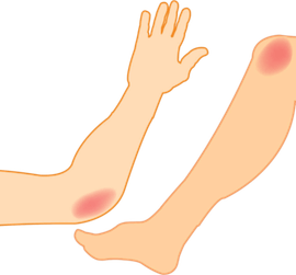 Bruise PNG